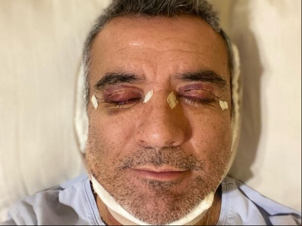 La primera foto del presentador que preocupó a sus fanáticos. Se trataba de una cirugía estética (Foto: Héctor Sandarti / Instagram)
